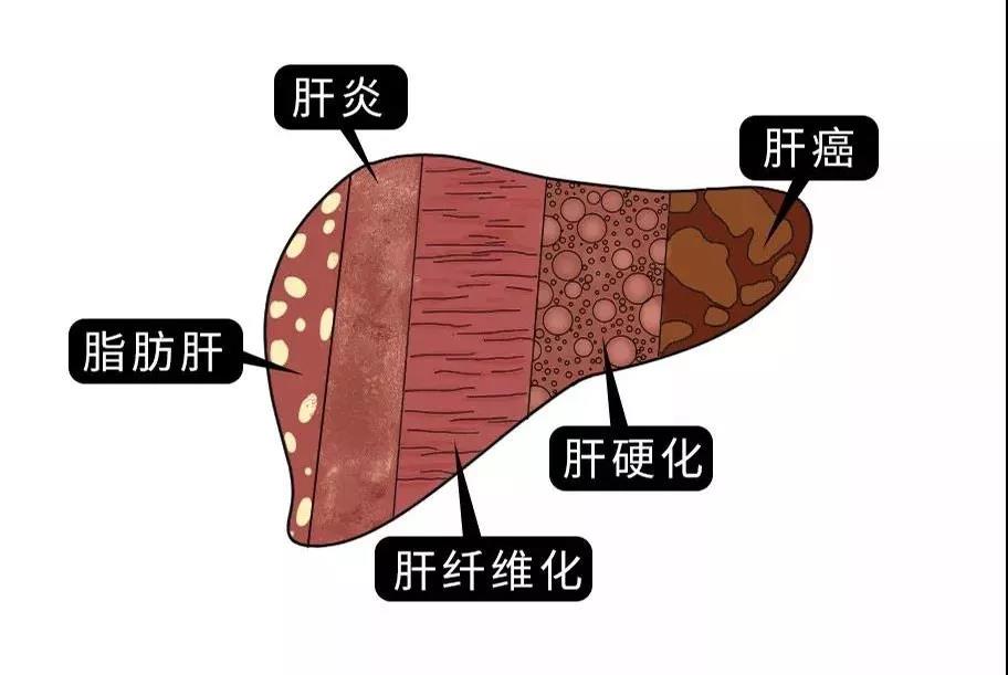 脂肪肝的最大敵人不是肥胖，答案竟是這樣！