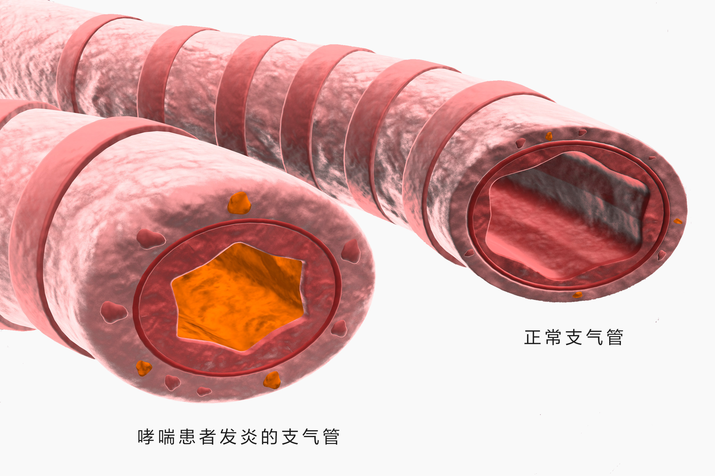 哮喘1.jpg 哮喘1.jpg