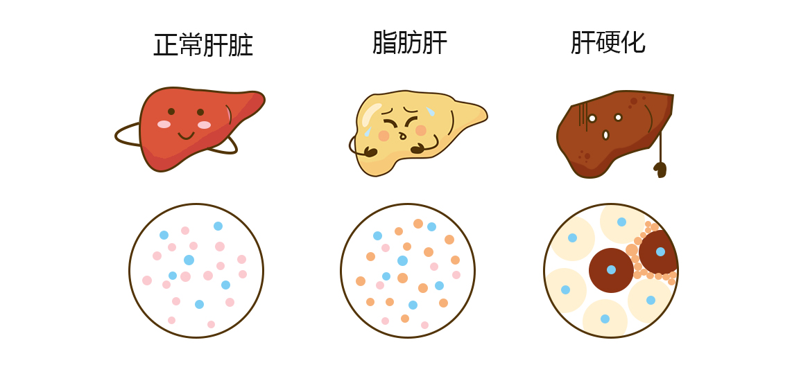 脂肪肝進程.jpg 脂肪肝進程.jpg